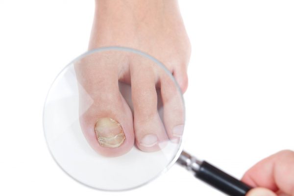 Болести на ноктите – не ги игнорирајте овие симптоми